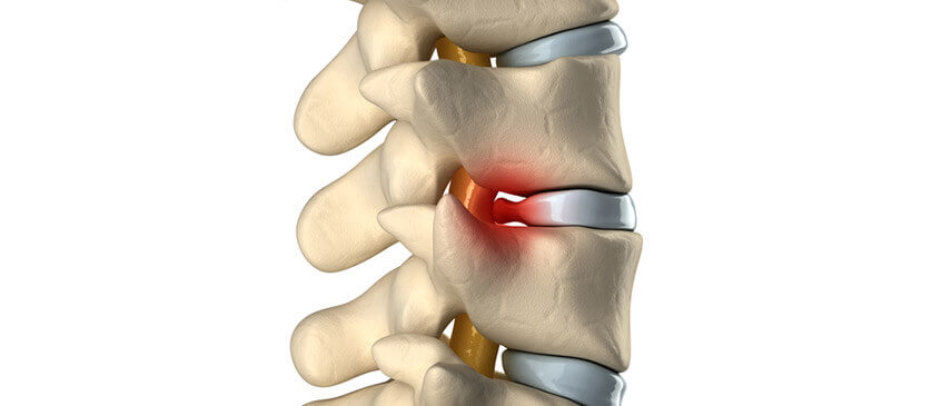 Herniated Discs | 7 Tips for Relieving Pain