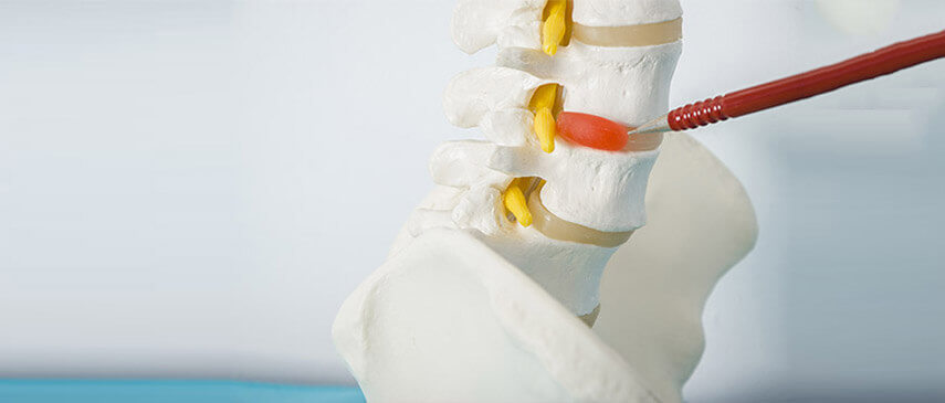 How Do You Know if You Have a Herniated Disc?